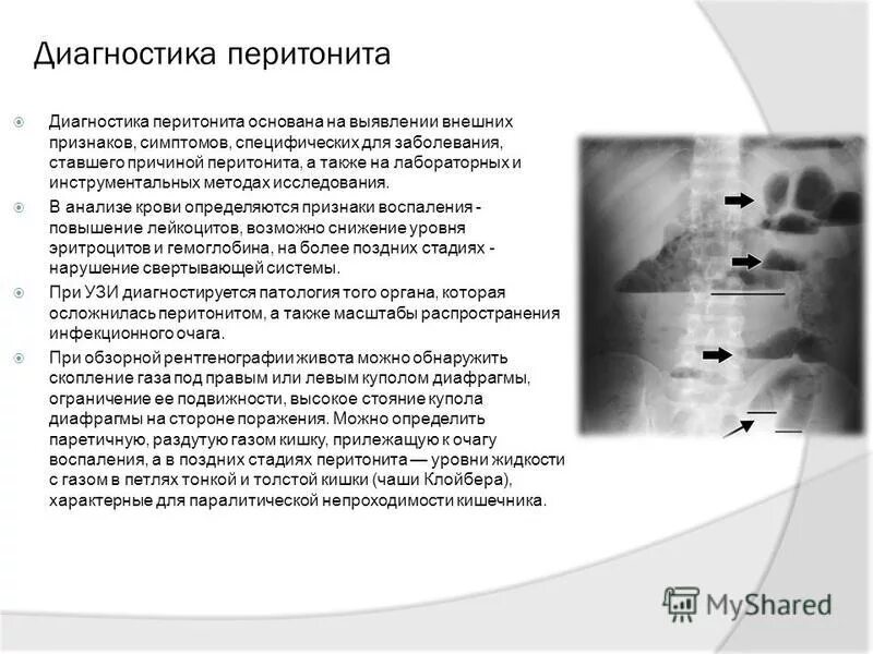 Диагностика перитонита. Инструментальные методы диагностики перитонита. Методы исследования при перитоните. Инструментальные методы исследования при перитоните.