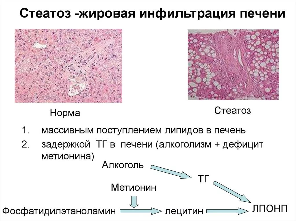 Признаки дистрофии печени. Жировой гепатоз печени гистология. Жировая дистрофия печени (стеатоз печени). Стеатоз печени макропрепарат. Механизм развития жировой инфильтрации печени.