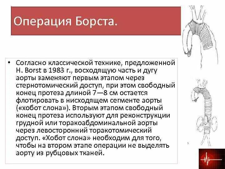 Операция Борста хобот слона. Протез восходящего отдела аорты. Протезирование аорты операция. Аневризма показания к операции