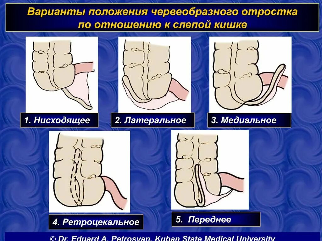 Аппендикс относится. Положения отростка аппендикса. Аппендикс это отросток слепой кишки. Варианты расположения червеобразного отростка. Положение аппендикса в брюшной полости.