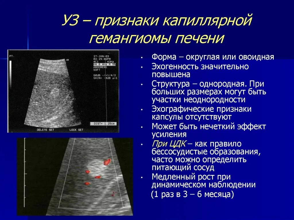 Что значит эхогенность печени. УЗИ картина кавернозной гемангиомы печени. Очаговые образования в печени на УЗИ. УЗИ признаки гемангиомы.