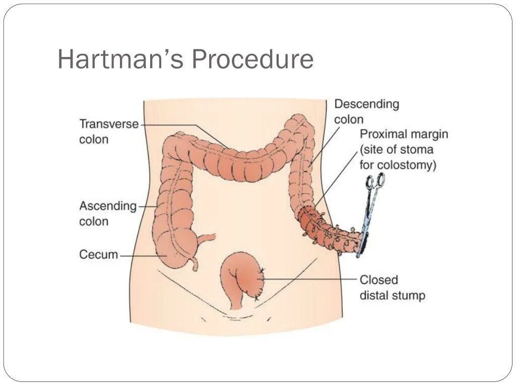 Colon перевод. GD Colon. Операция Хартманна этапы.