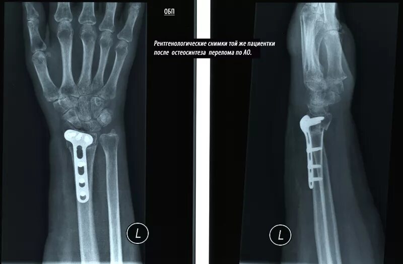 перелом лучевой кости пластиной операция. открытая репозиция перелома лучевой кости. остеосинтез диафиза локтевой кости. остеосинтез перелома лучевой кости. остеосинтез дмэ лучевой кости.