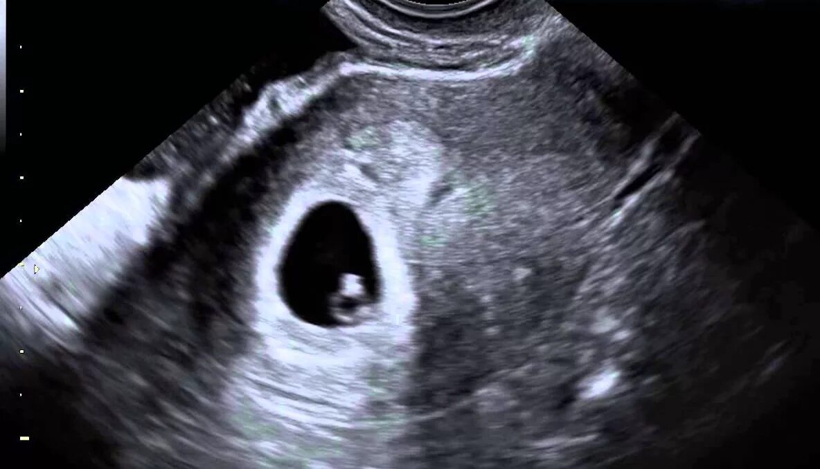 Вторая беременность 6. Вторая беременность 6. Животик на 5 месяце. Живот по неделям. Беременный живот 6 недель.