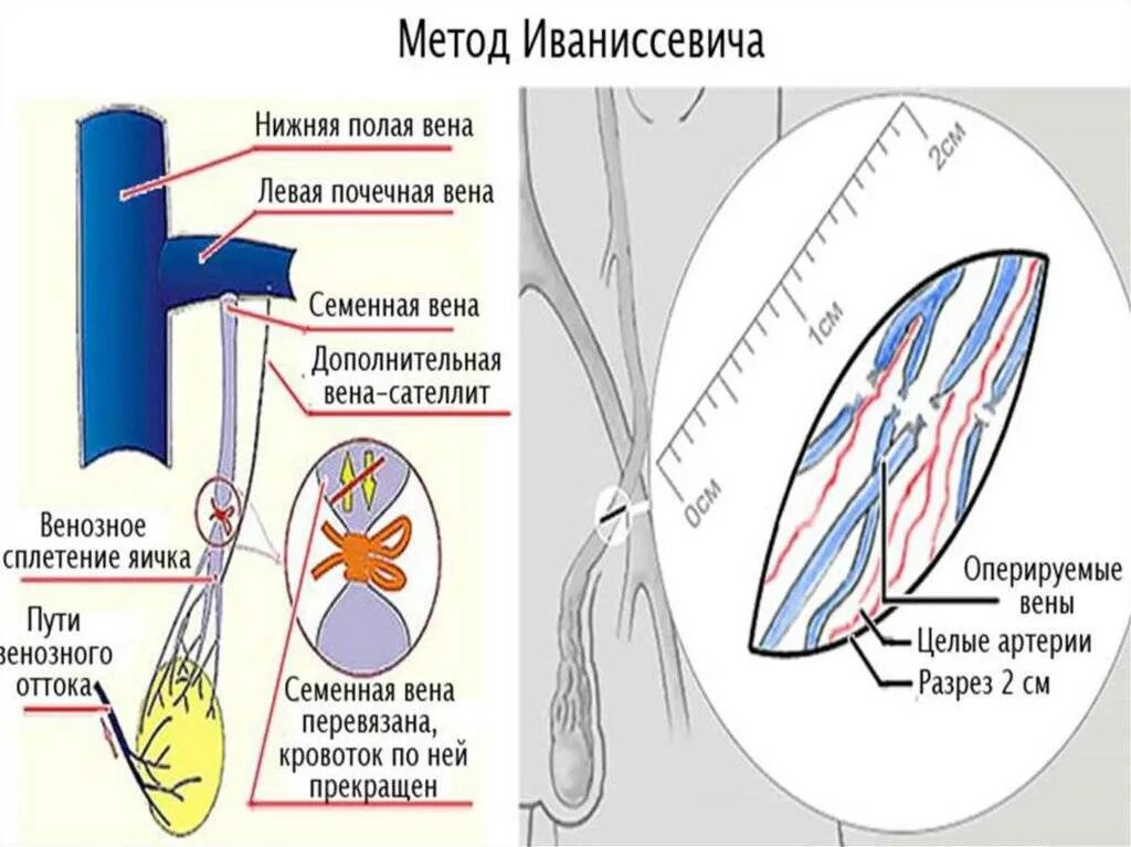 Варикоцеле паломо. Операциях иваниссевича и паломо;. Операция мармара (микрохирургическая варикоцелэктомия). Лапароскопия яичка варикоцеле. Варикоцеле паломо.