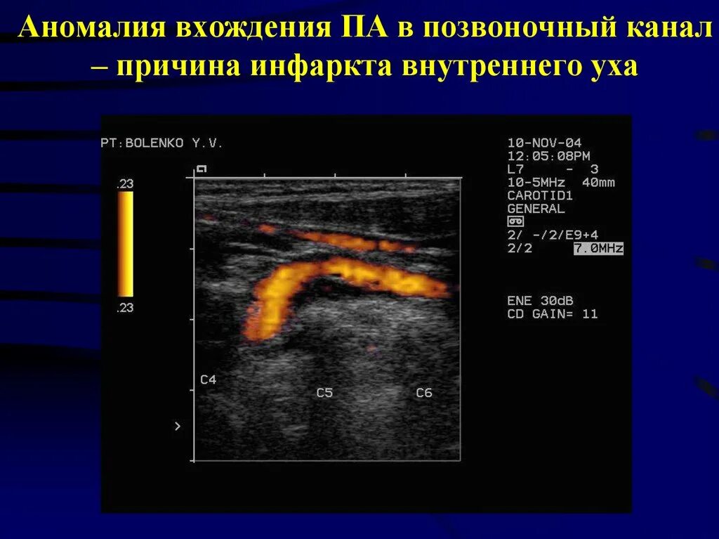 Канал без причины. Высокое вхождение позвоночных артерий в костный. Высокое вхождение позвоночной артерии в костный канал. Высокое вхождение позвоночных артерий в канал. Позвоночные артерии УЗИ.