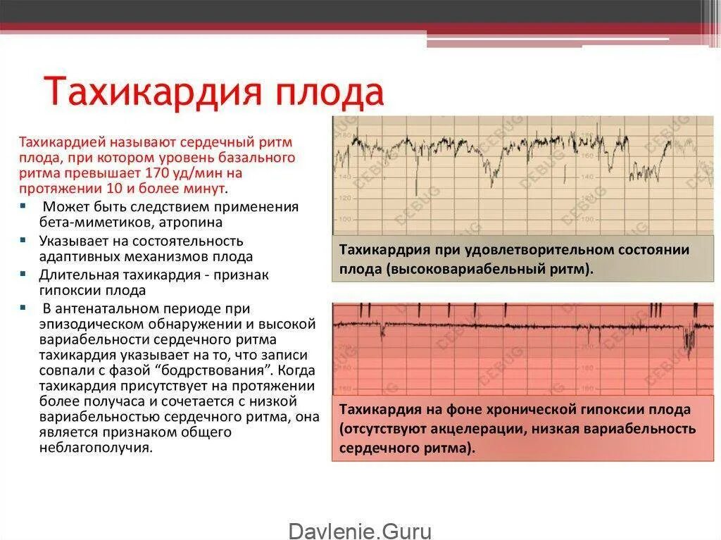 Сердцебиение повышено причины. Причины тахикардии плода. тахикардия на ктг у плода. тахикардию у плода вызывают. тахикардия плода при беременности.