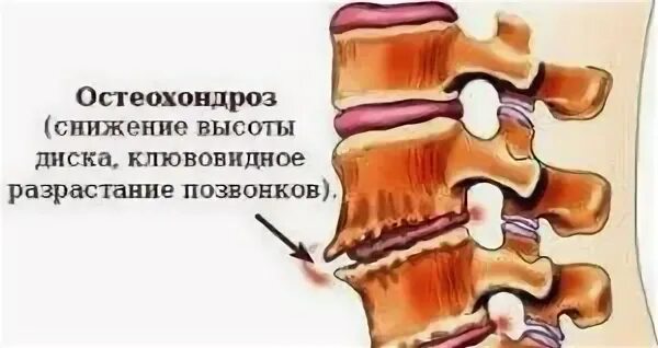 Краевые костные разрастания позвоночника. Шейный остеохондроз памятка. профилактика остеохондроза памятка. памятка по остеохондрозу. клювовидные разрастания тел позвонков.