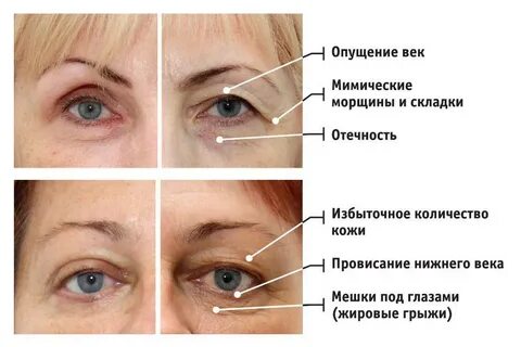 Птоз века как избавиться