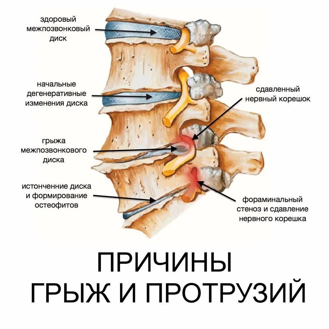 Болит ли протрузия. Грыжа межпозвонквого дискапозвонок. Остеохондроз протрузии межпозвонковых дисков. Грыжа позвоночника поясничного отдела дисксковая. Анатомия Корешков поясничного отдела позвоночника.