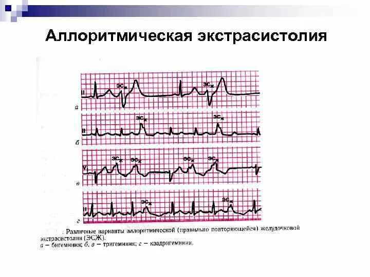 Нарушение ритма по типу экстрасистолии. Аллоритмическая экстрасистолия. аллоритмическая экстрасистолия на экг. экстрасистолия клиника. классификация экстрасистолии бигеминии.