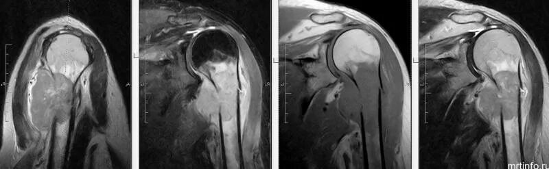 Делают ли мрт руки. Мрт опухоли в кости плечевого сустава. Капсулит плечевого сустава на кт. Подвывих плечевого сустава мрт. Мрт плечевого сустава норма.