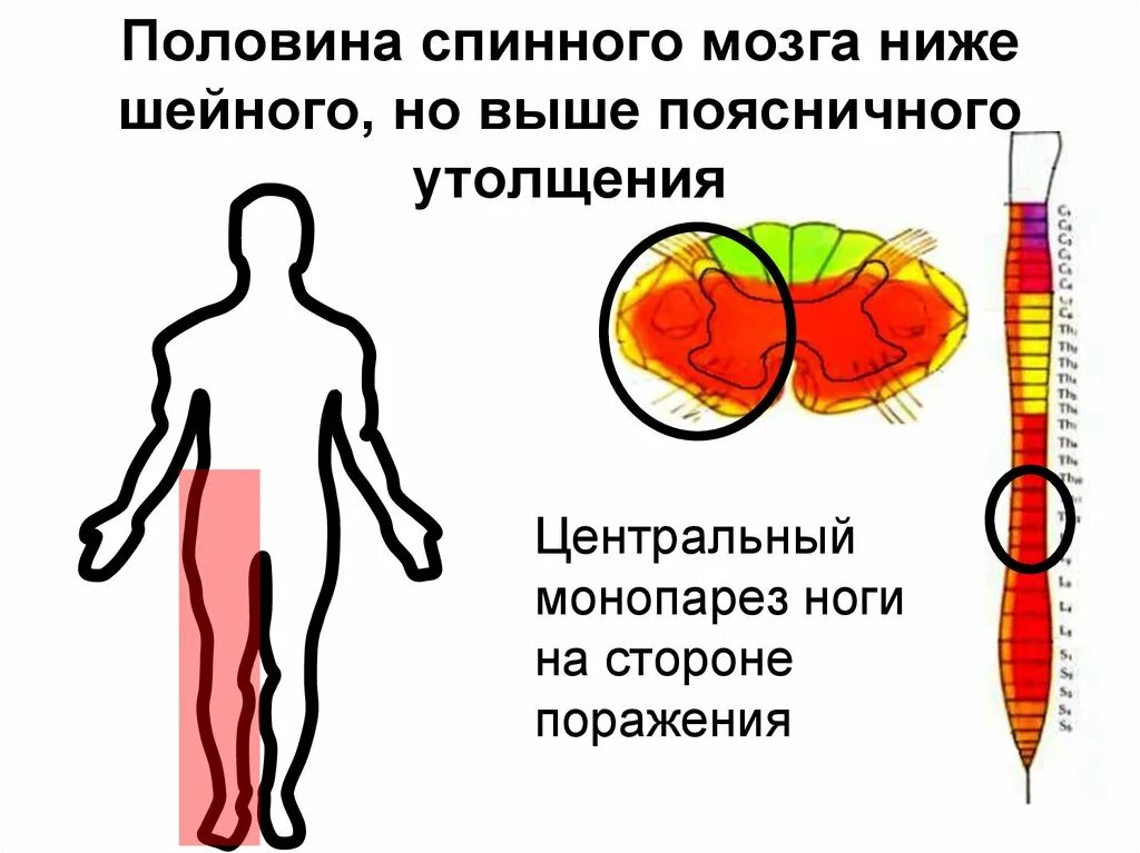 Поражение половины мозга. Синдром поражения поясничного утолщения. Поражение спинного мозга ниже шейного утолщения. Синдром поражения шейного утолщения спинного мозга. Симптомы поражения поясничного утолщения спинного мозга.