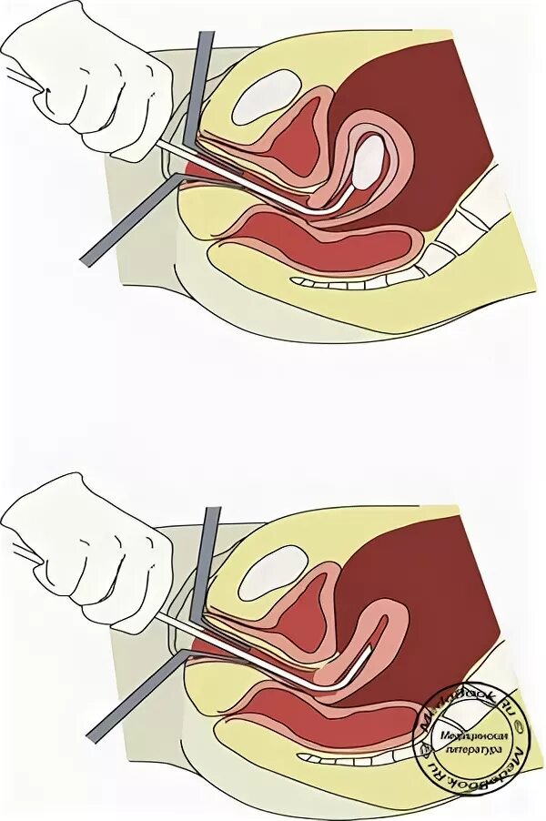 вакуумная аспирация прерывание беременности. пайпель биапсия эндометрит. вакуум аспирация замершей беременности. вакуум аспирация при беременности. вакуум аспирация аборт.