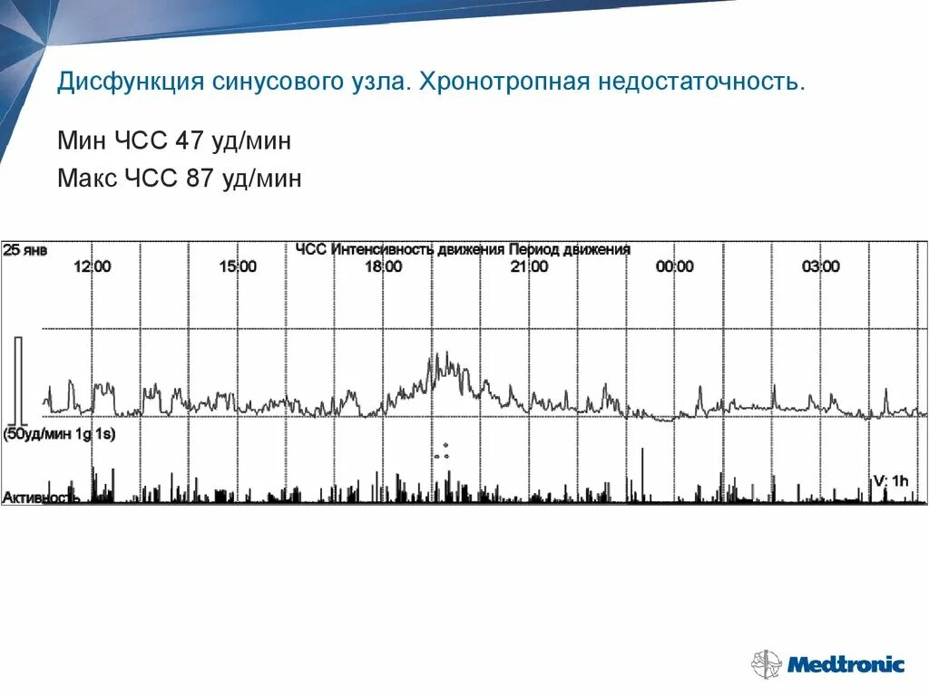 Дисфункция синусового узла что это. Дисфункция синусового узла. Дисфункция синусного узла. Критерии дисфункции синусового узла. Хронотропная недостаточность.