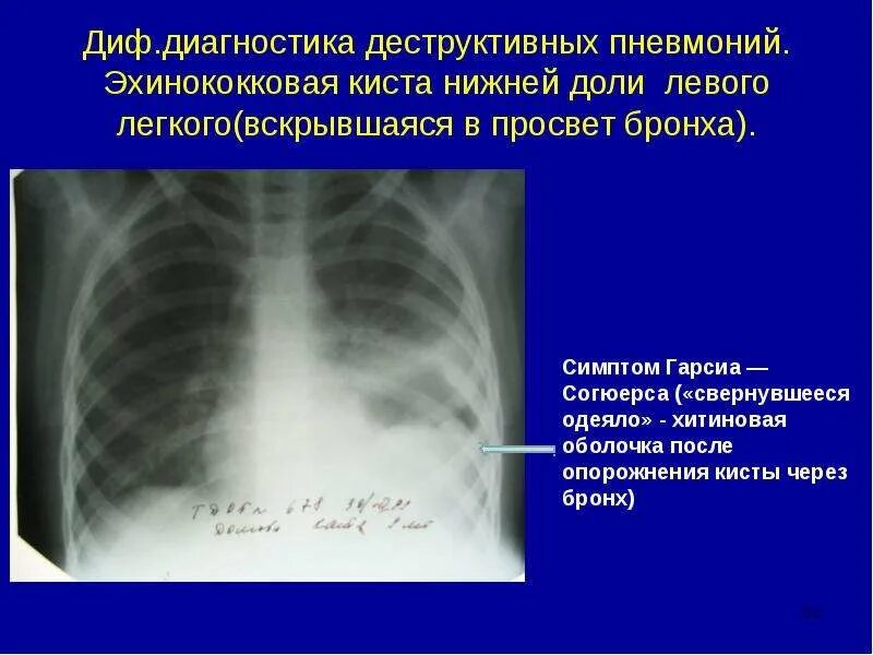 Эхинококковая киста легкого дифференциальная диагностика. Пневмония нижней доли рентген. Киста лёгкого дифференциальная диагностика. Пневмония нижней доли левого легкого рентген. Образование левой доли легкого