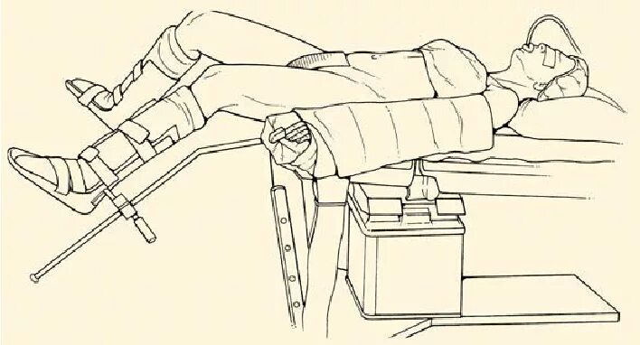 Положение больного на столе. Операция Тренделенбурга. Положение Тренделенбурга на операционном столе. Положение пациента на операционном столе. Пациент на операционном столе.