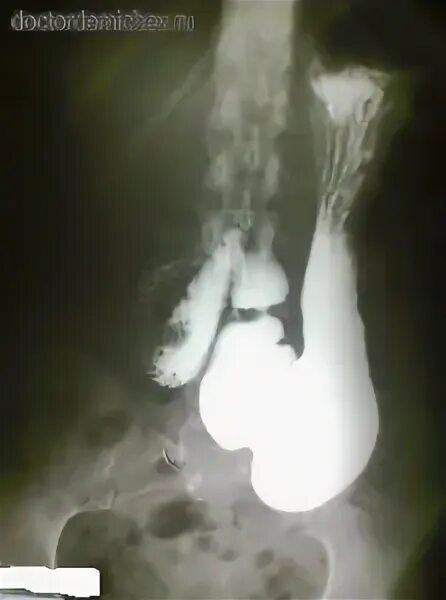 Рентгеноскопия желудка ,гастроптоз. Гастроптоз желудка симптомы. Гастроптоз степени рентген. Гастроптоз желудка рентген. Гастроптоз степени рентген.