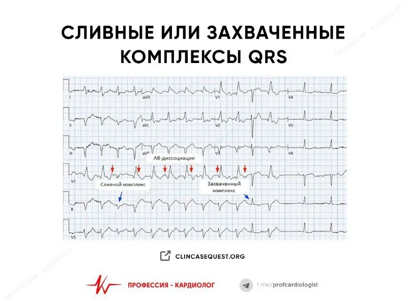 заключение холтер экг при экс. сливные комплексы на экг. псевдосливной комплекс на экг. экг критерии парасистолии желудочковой. сливные комплексы на экг.
