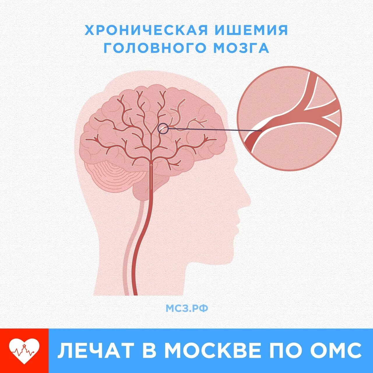 Причины ишемии мозга. Иш имия головного мозга. Хроническая ишемия головного мозга. Хроническая ишемия головного могза. Ишемические участки мозга.