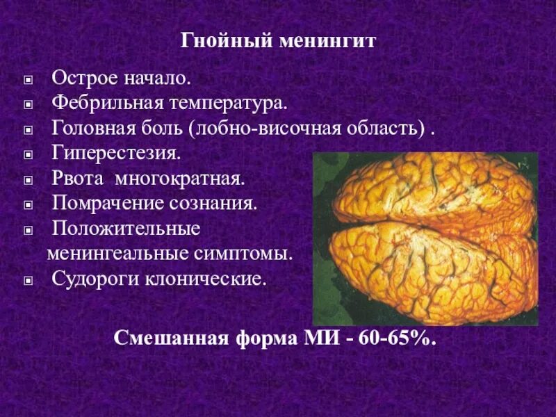 Менингококковый Гнойный менингит. Острый Гнойный менингит. Гнойный менингит головного мозга.