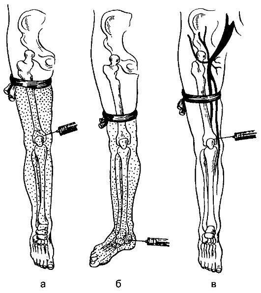 Внутрикостная блокада. Внутрикостная регионарная анестезия. Проводниковая анестезия нижней конечности. Методика внутрикостной анестезии. Проводниковая (регионарная) анестезия.