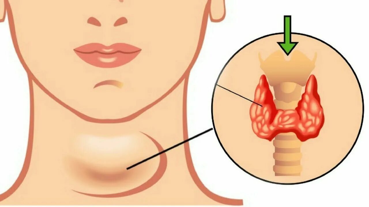 После железа. Киста зоба щитовидной железы. Послеоперационный гипотиреоз щитовидной железы. Щитовидка и кишечник связь.