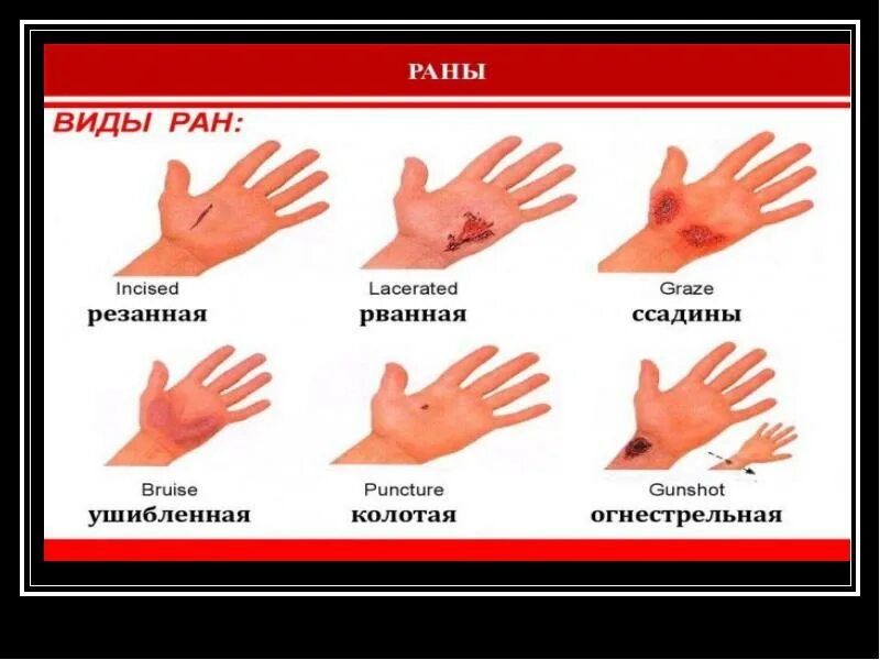 Какие виды ран. Какие виды ран