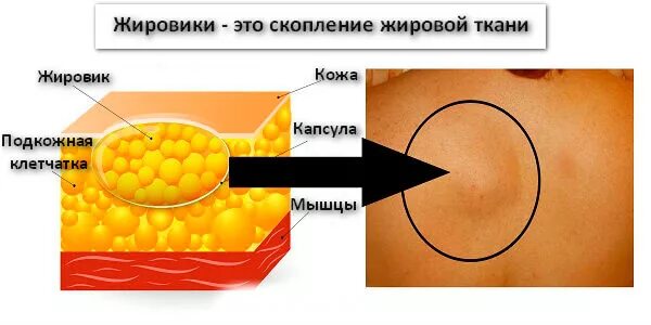 Подкожно-жировая клетчатка липома. Липома жировой клетчатки. Липома капсула жировая. Уплотнения в жировой ткани. Капсула жировика