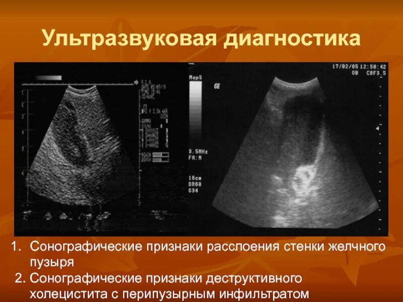 Изменение стенок желчного пузыря. Острый калькулезный холецистит на узи. острый деструктивный холецистит узи. абсцесс стенки желчного пузыря узи. узи острый холецистит перивезикулярный инфильтрат.