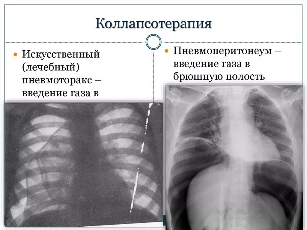 Коллапсотерапия при туберкулезе. Искусственный пневмоторакс при туберкулезе техника. наложение пневмоперитонеума при туберкулезе. наложение искусственного пневмоторакса при туберкулезе. коллапсотерапия туберкулеза.