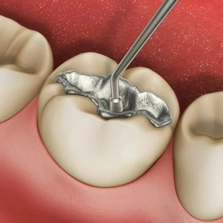 Цельнокерамическая вкладка на зуб. Сколько нельзя кушать после установки пломбы. Металлическая пломба стоматология. Рекомендации после лечения кариеса. Пломбы стоматологические.