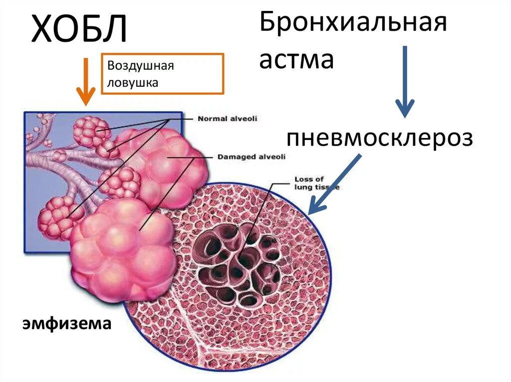 Хроническими болезнями легких астмой. Воздушная ЛОВУШКА при ХОБЛ. Хроническая обструктивная болезнь легких этиология. Механизм развития эмфиземы при ХОБЛ. ХОБЛ И бронхиальная астма.