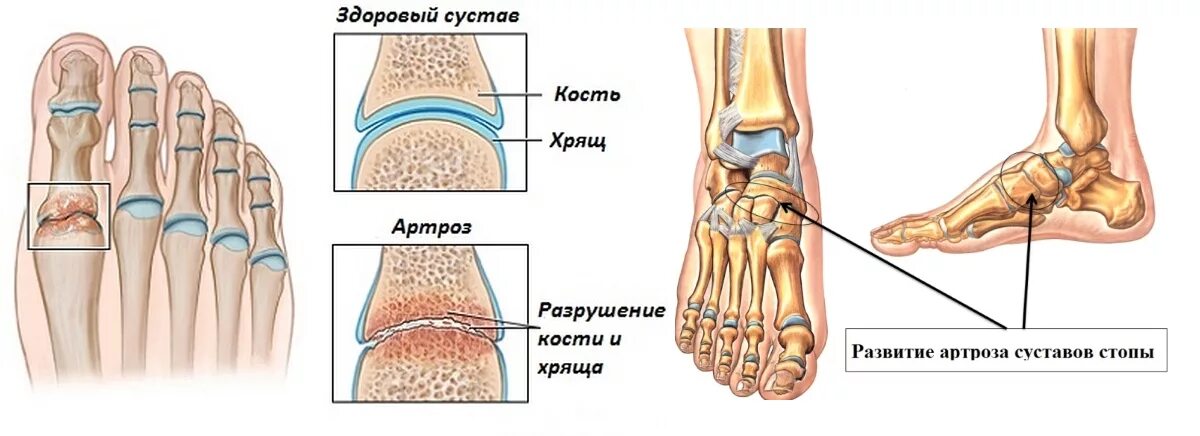 Лечение артрита суставов в домашних условиях