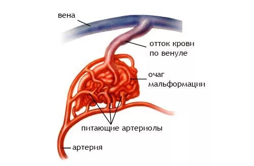 Сосудистая аномалия. Артериовенозная мальформация артерии. Артериовенозная мальформация классификация. Артерия венозная мальформация. Мальформация кишечника.