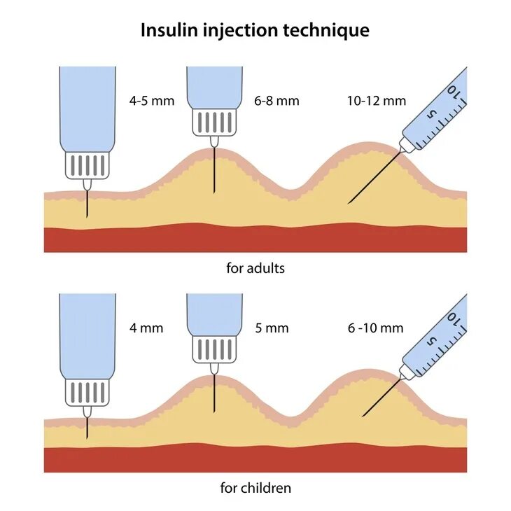 Техника набора инсулина. Иглы 6-8мм для инъекции инсулина. Угол введения иглы инсулина. Угол введения инсулина. Техника инъекций инсулина.