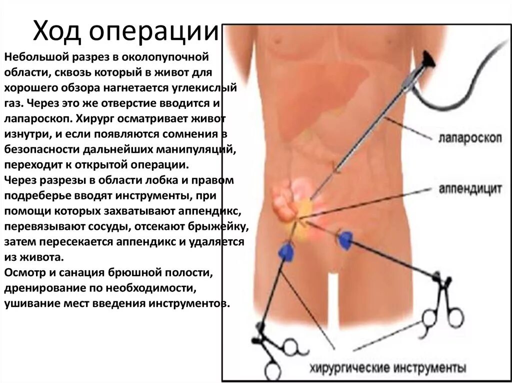 Боль в животе после аппендэктомии