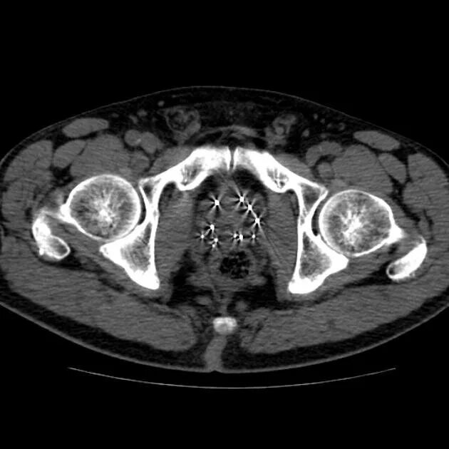 Кт малого таза с контрастом у мужчин. Опухоль предстательной железы кт. Предстательная железа кт норма. Брахитерапия предстательной железы на кт. Кальцинаты предстательной железы на кт.