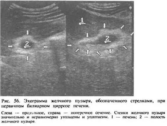 Камень в шейке желчного пузыря. Трехслойная стенка желчного пузыря. Выключенный желчный пузырь УЗИ. Склерозированный желчный пузырь.