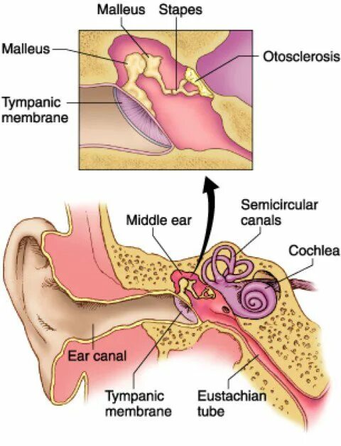 Кондуктивный отосклероз. Болезни среднего уха отосклероз. Кохлеарный отосклероз операция. Отосклероз слухового прохода. Отосклероз уха операция