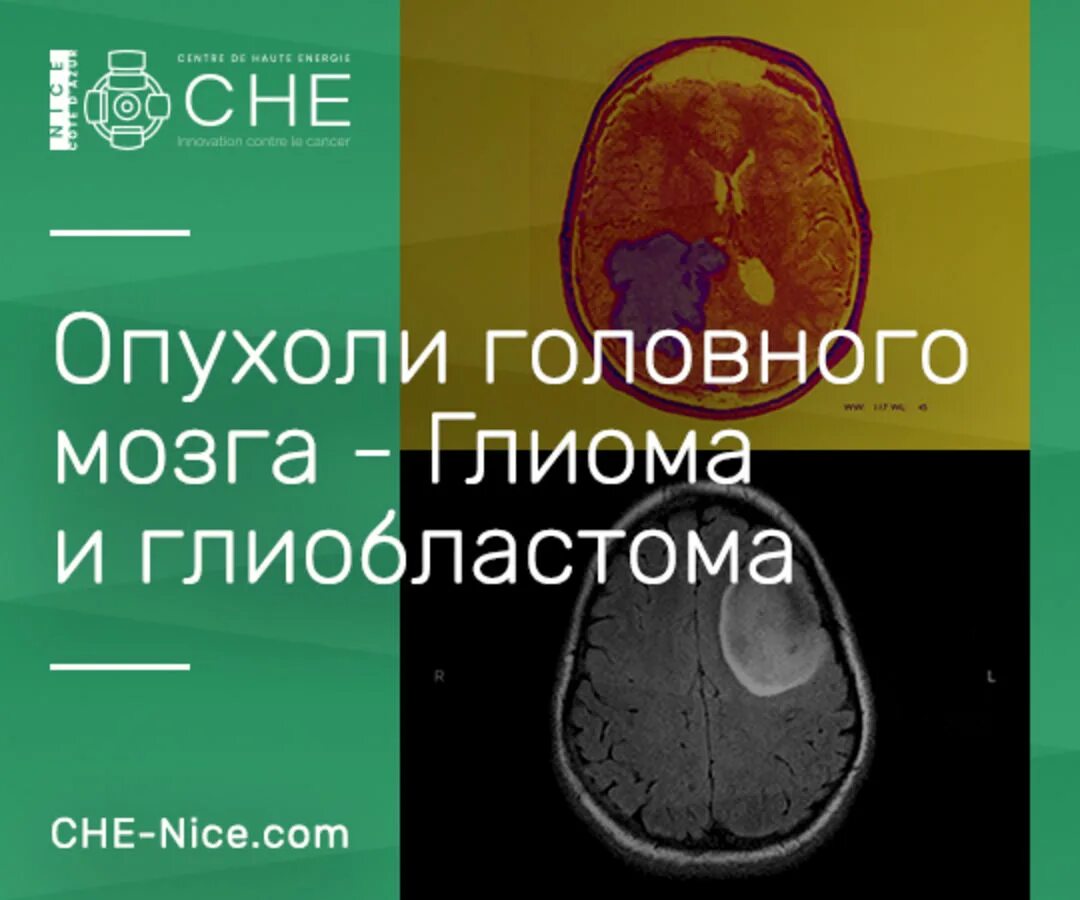 Можно ли вылечить рак мозга. Глубинная опухоль головного мозга. опухоль головного мозга лекция. гормонально активные опухоли головного мозга.