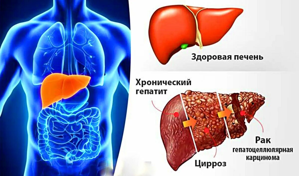 Здоровая ли печень. Осложнение хронического гепатита b. Хронический гепатит и цирроз печени. Печень при хроническом гепатите. Заболевания печени картинки.