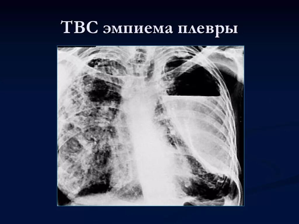 Туберкулезная эмпиема рентген. Эмпиема плевры, пиоторакс.. Эмпиема легкого