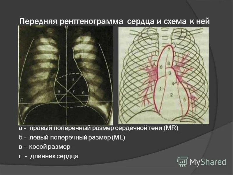 поперечный размер сердца. поперечник сердца в норме. поперечный размер сердца в прямой проекции представляет собой. поперечный размер сердца. норма длинника и поперечника сердца.