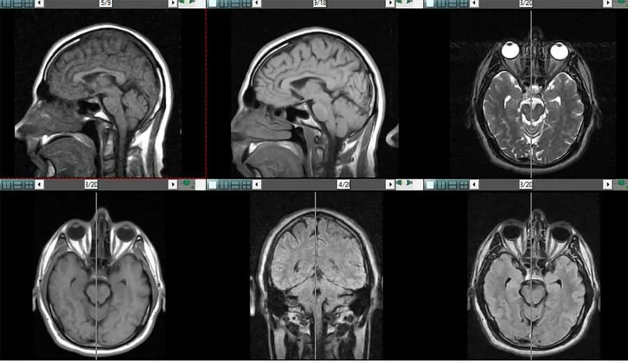 Мрт мозга опасно. Ликворография головного мозга магнитно-резонансная. Мрт головного мозга аксиальная проекция. Снимки мрт головного мозга. Кт головного мозга.