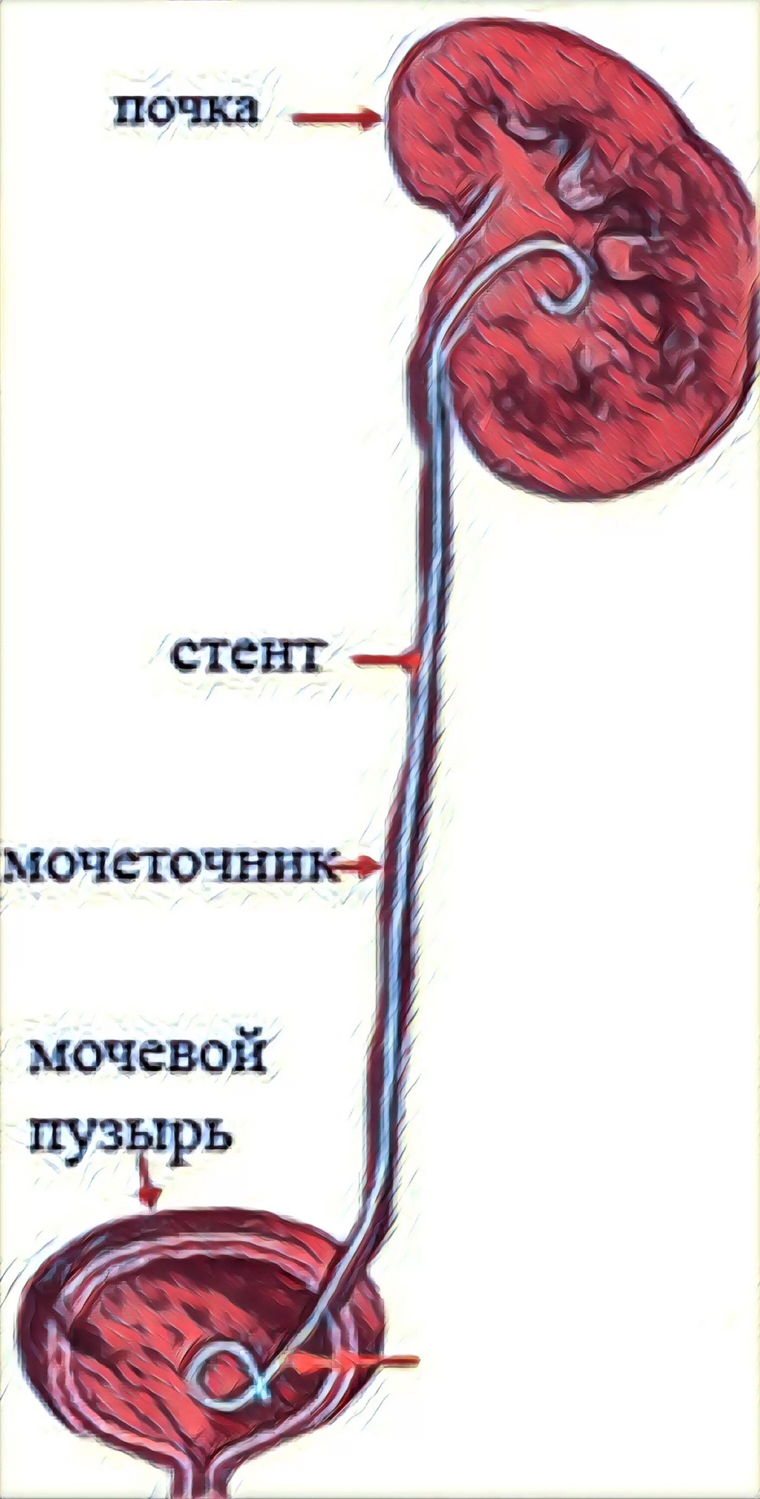 Мочеточник отходит от. Стенд урологический в мочеточнике. Урология стент в мочеточнике. Стенд из почки в мочеточник. Внутренний стент в мочеточнике.