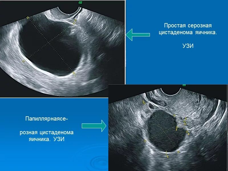 Объемные кистозные образования