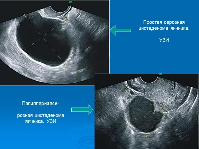 Как отличить кисту. Цистаденома и киста яичников. Доброкачественные опухоли яичников УЗИ. Доброкачественная опухоль яичника УЗИ. Муцинозной кисты яичника ..