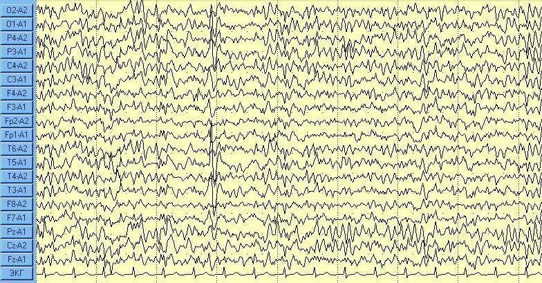 Ээг минск. Электроэнцефалография эпилепсия. ЭЭГ здорового человека и эпилептика. Эпилепсия на ЭЭГ. ЭЭГ головного мозга эпилепсии.