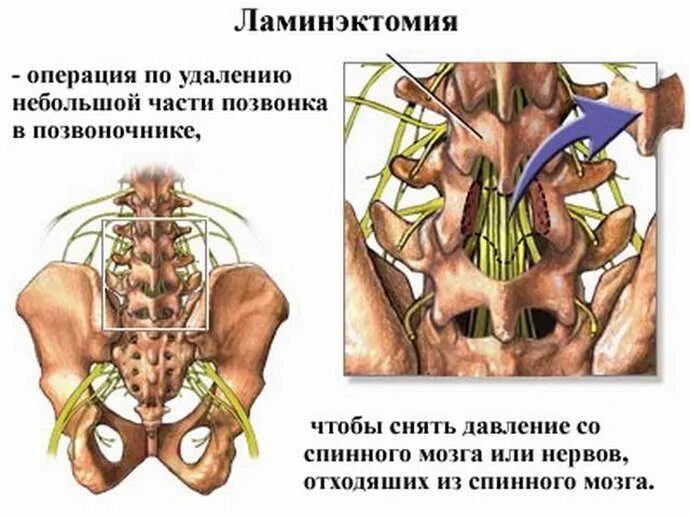 Ламинэктомия позвоночника этапы операции. Ламинэктомия поясничного отдела позвоночника. Декомпрессивная ламинэктомия позвонков l4-l5. Операция ламинэктомия на позвоночнике. Отек позвоночника после операции